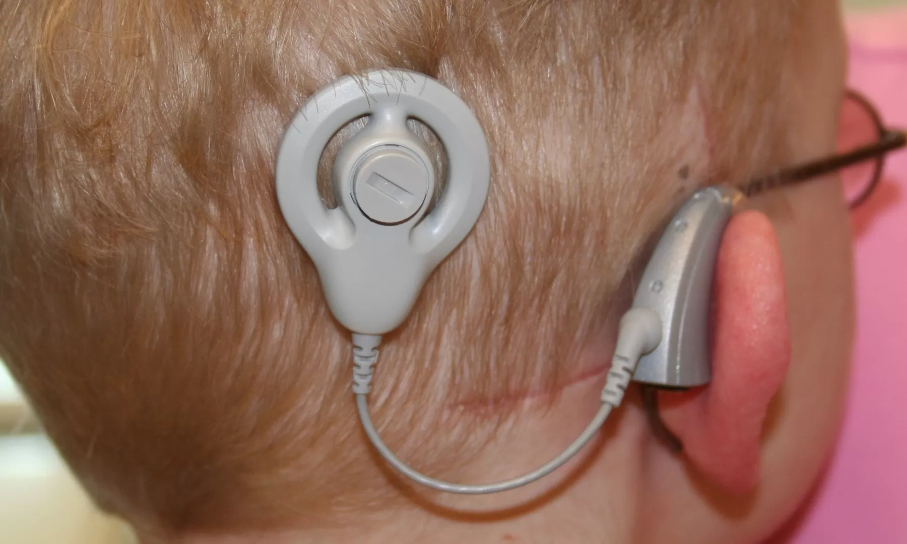 Por primera vez en Casanare se realizan implantes auditivos a dos menores de edad