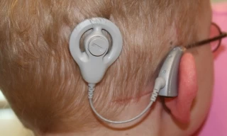 Por primera vez en Casanare se realizan implantes auditivos a dos menores de edad